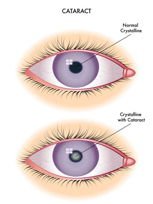 Reference Pricing for Cataract Surgeries