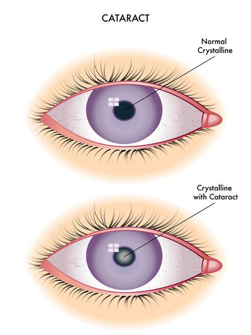 Reference Pricing for Cataract Surgeries Reference Pricing for Cataract Surgeries